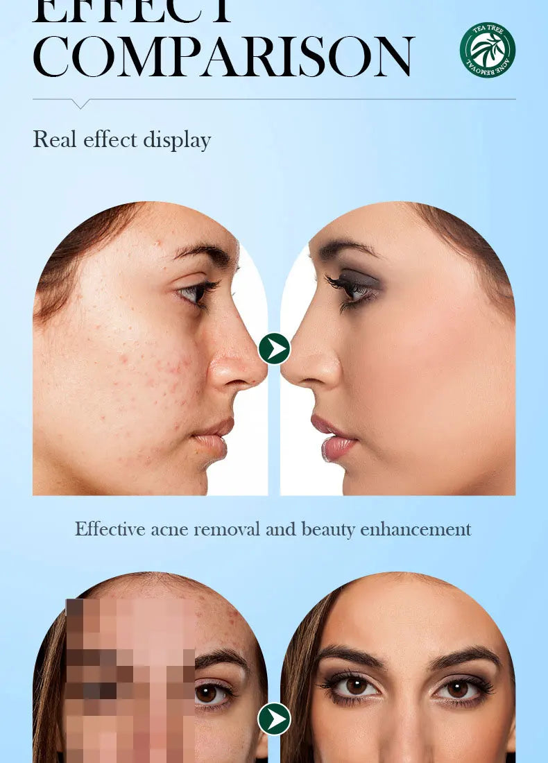 SADOER Tea Tree Acne Removing Cream